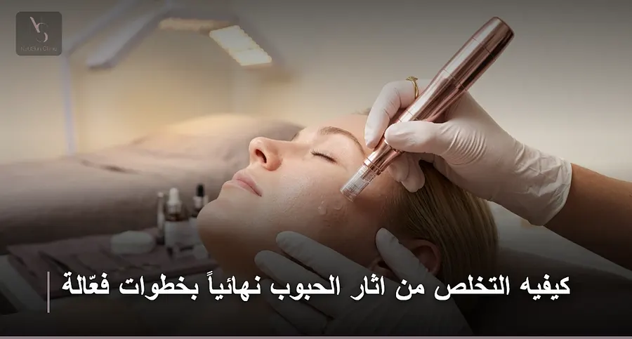 كيفيه التخلص من اثار الحبوب