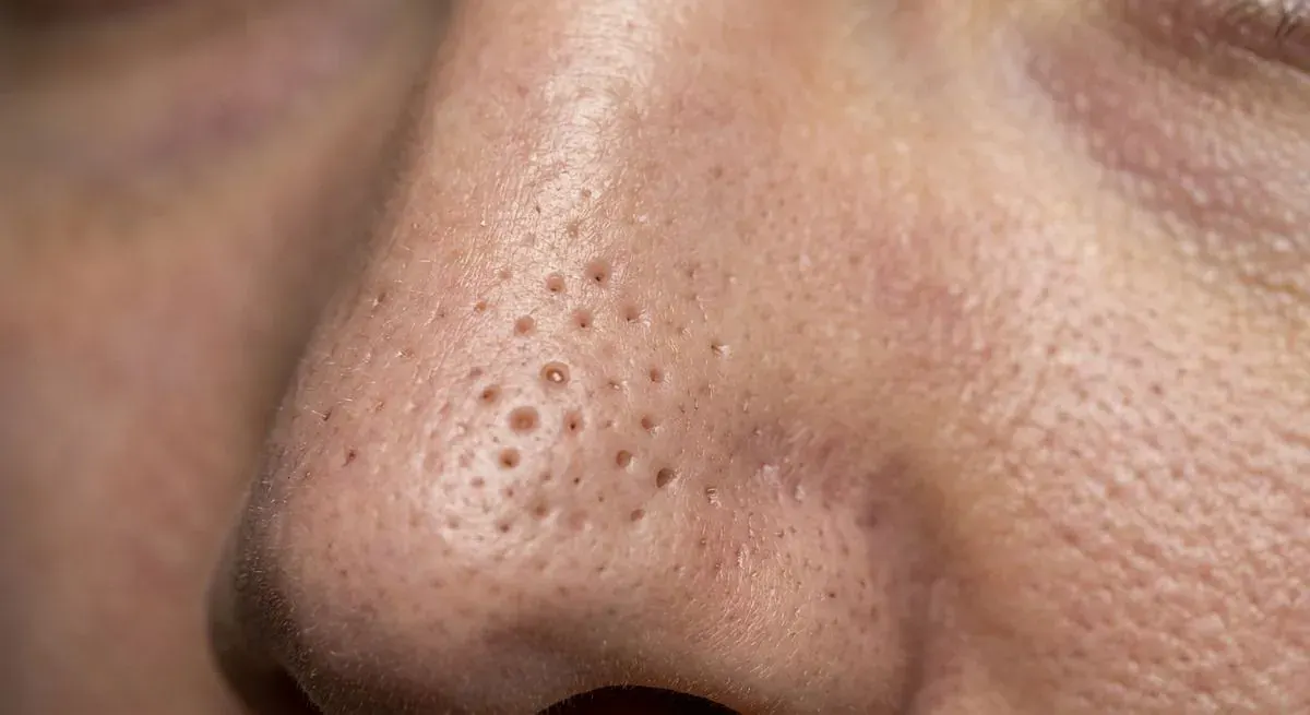 Reducing Enlarged Pores on the Face